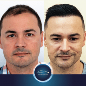 The Remarkable Transformation: Before and After Hair Transplant in Turkey