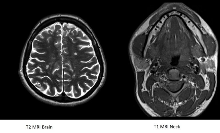 Critical Role of T1 and T2 MRI Sequences in Optic Nerve Glioma Imaging
