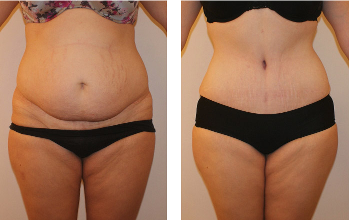 Finding a Qualified Surgeon for Lipo 360 Without a Tummy Tuck