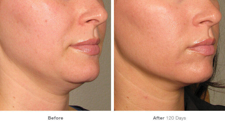 Ultherapy: A Non-Surgical Approach to Lifting and Tightening Skin