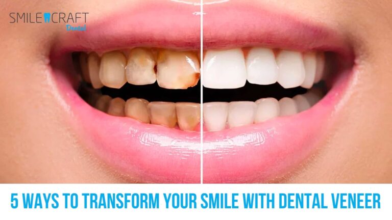 Transform Your Smile with Dental Veneers in Edmonton