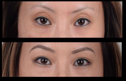 Achieve Brighter, More Open Eyes with Double Eyelid Surgery