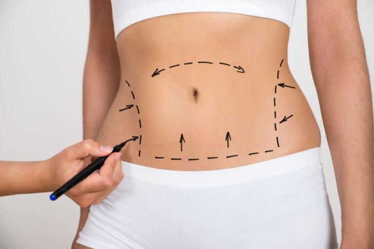 Laser Liposuction in Austin: What You Need to Know